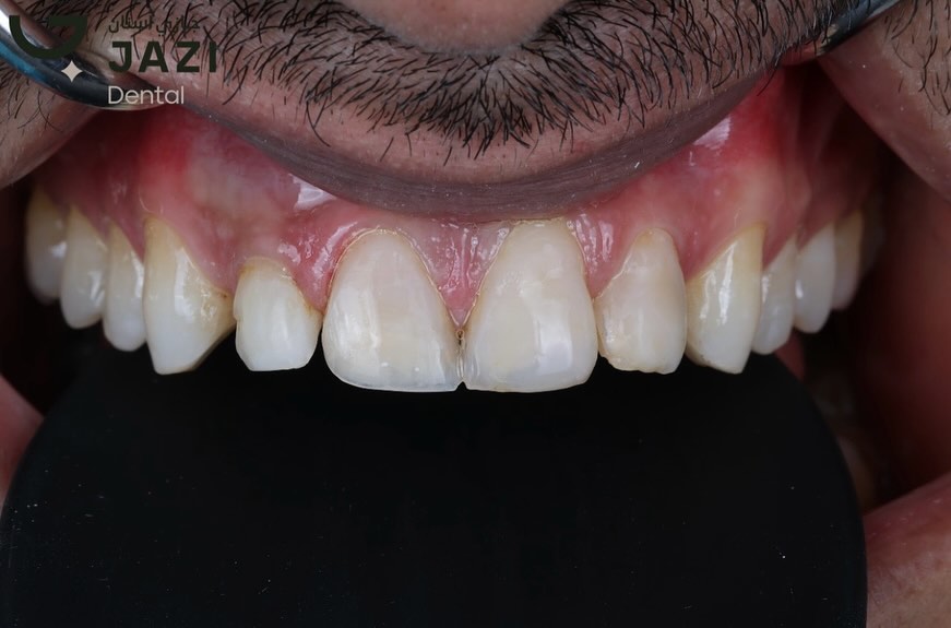 حالة بعد العلاج ٥