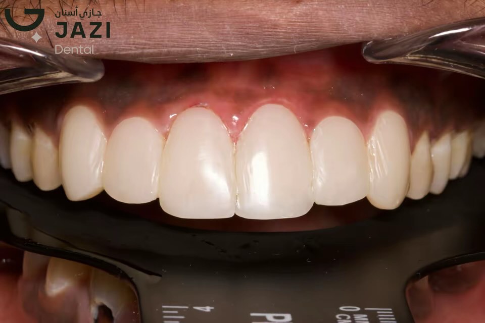 حالة بعد العلاج ٦