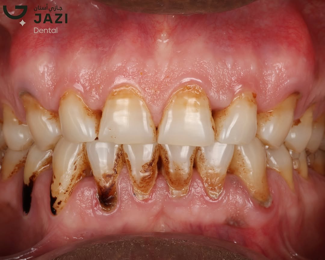 حالة قبل العلاج ٢