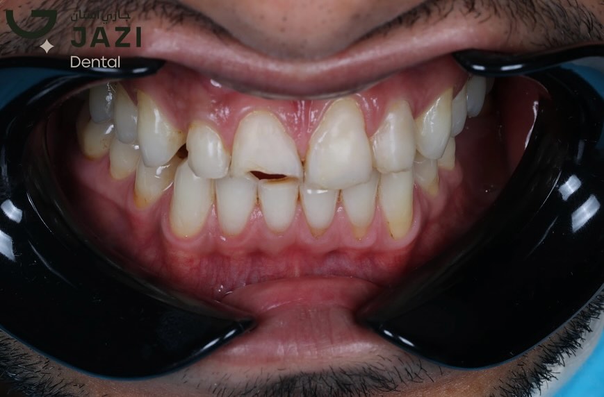 حالة قبل العلاج ٥