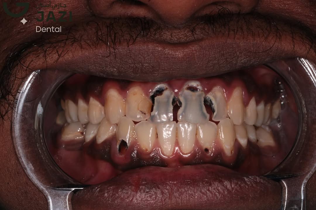 حالة قبل العلاج ٦